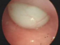 多科合作完成首例新生儿困难气道经支气管镜引导下气管插管