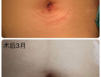 哪里靠谱的买球平台妇科
成功实施单孔腹腔镜手术治疗妇科恶性肿瘤
