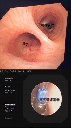 气管食管瘘图片图片