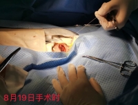 出生体重1190g的星星顺利完成食管闭锁端吻合术！
—— 记“千克”宝宝的外科之路