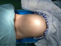 我院妇科王平教授团队成功完成一例特殊的“剖腹产”